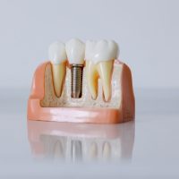 Full Mouth Dental Implants in Turkey Package Deals: Reviews and Price